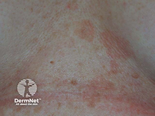 Pityriasis versicolor