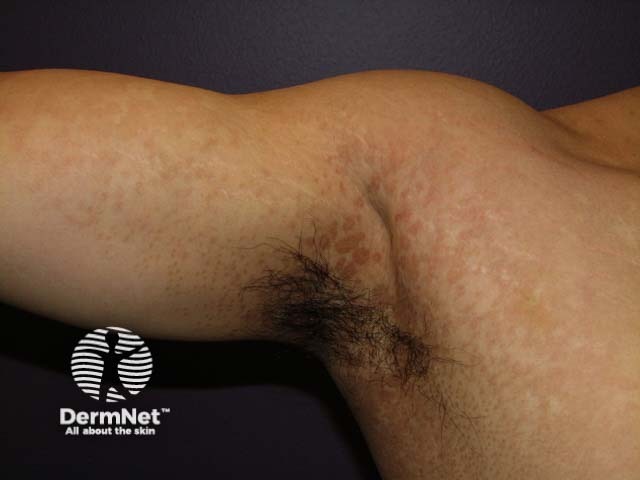 Pityriasis versicolor