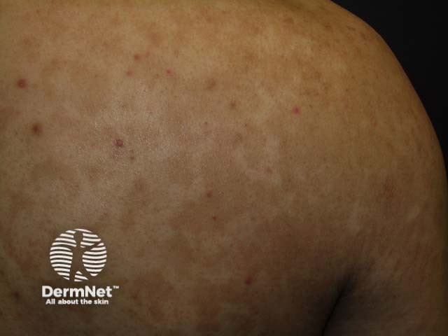 Pityriasis versicolor