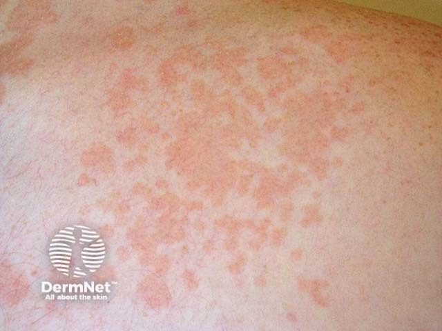 Pityriasis versicolor