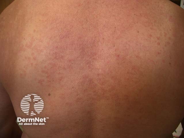 Pityriasis versicolor