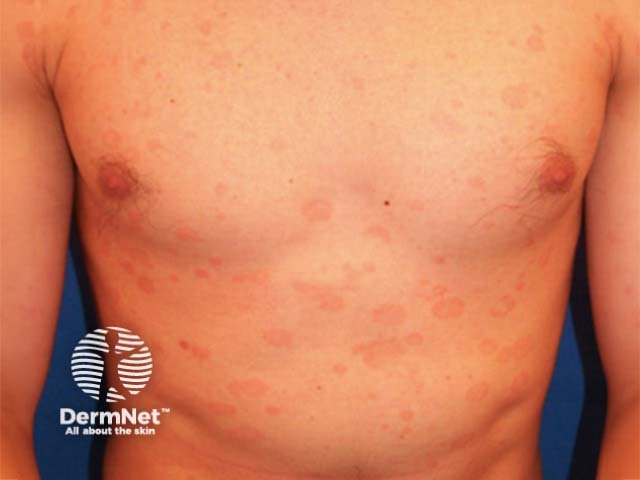 Pityriasis versicolor