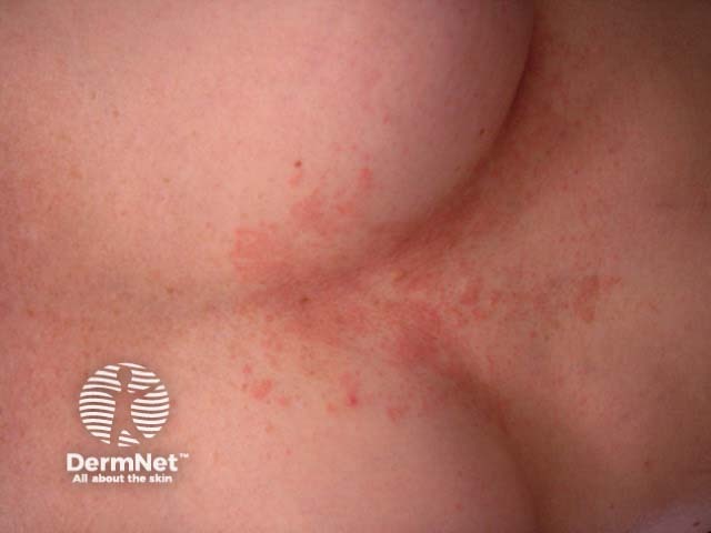 Pityriasis versicolor