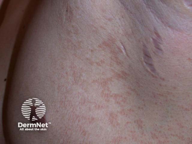 Pityriasis versicolor