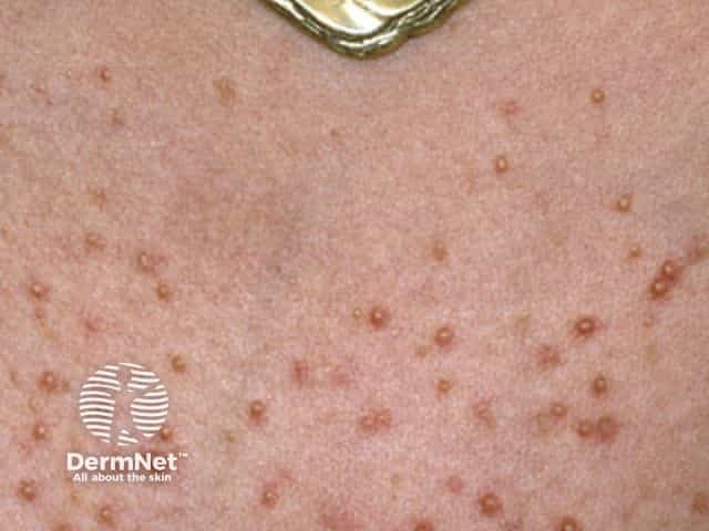 Malassezia folliculitis