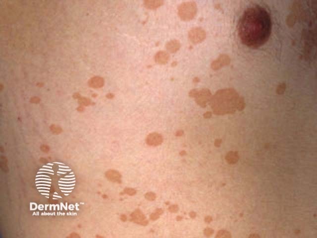 Pityriasis versicolor