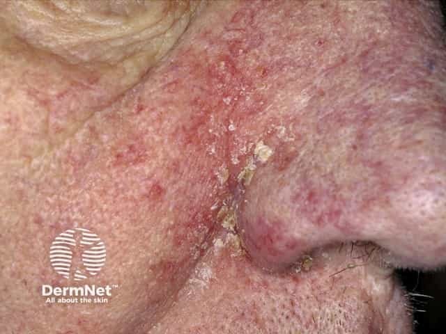 Seborrhoeic dermatitis