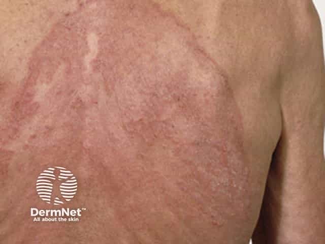 Extensive tinea corporis that has spread despite oral terbinafine should alert to antifungal resistance