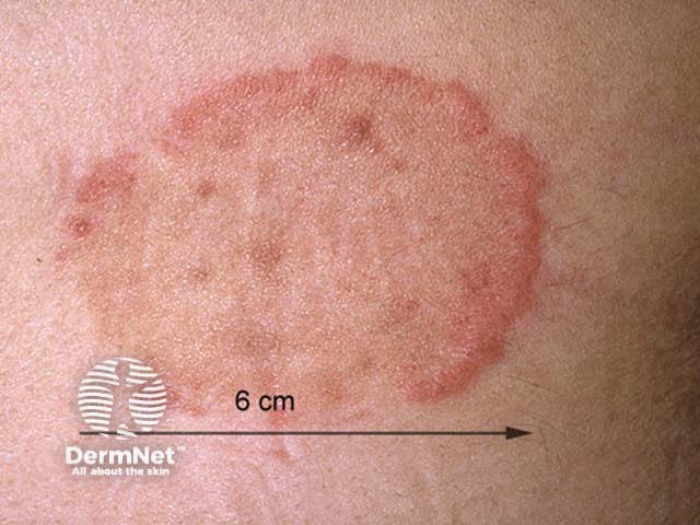 Tinea corporis