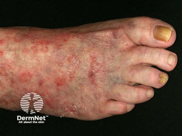 Tinea pedis