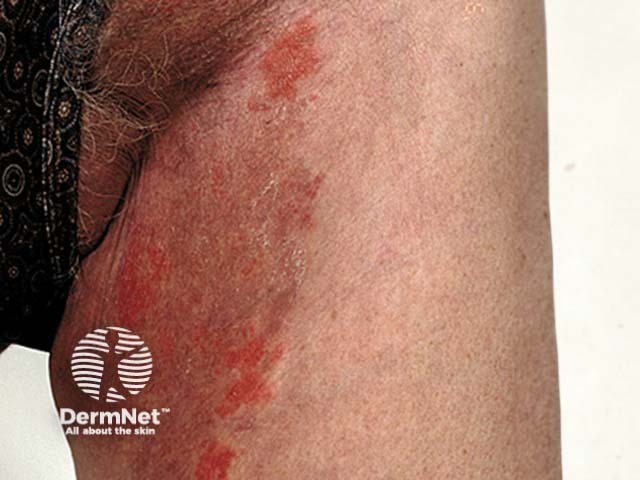 Tinea incognita - groin