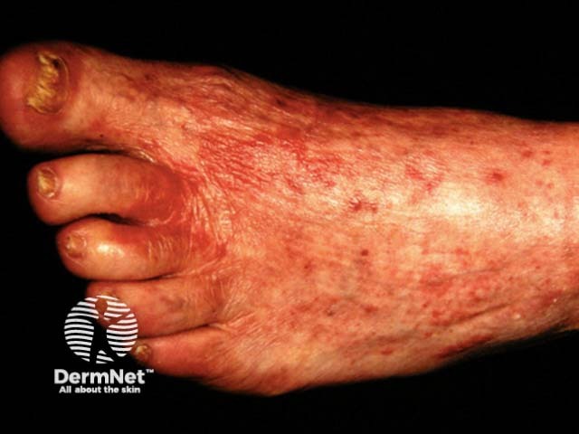 Tinea incognita - foot