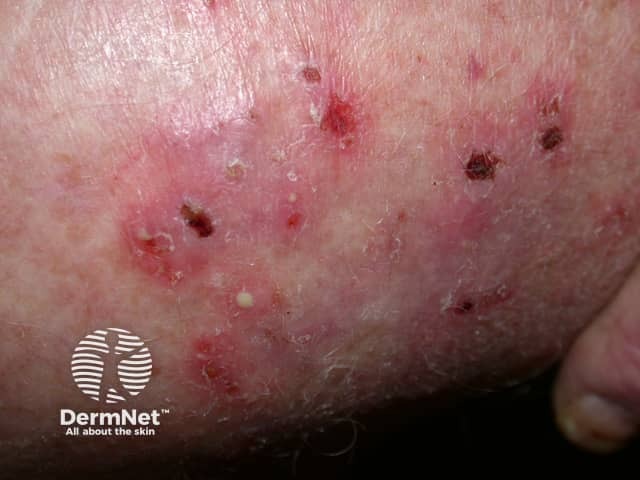 Papules and pustules of tinea corporis