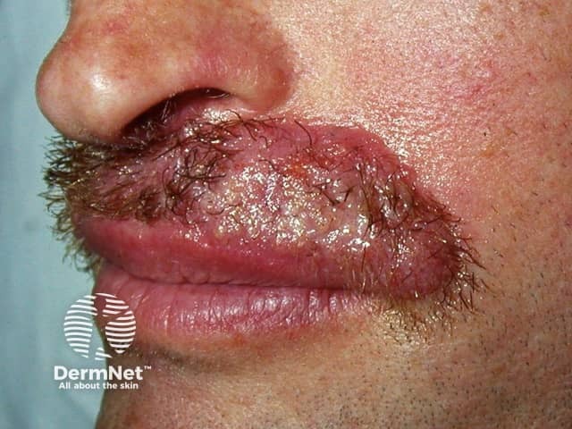 Fungal beard infection