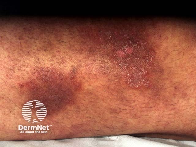 Tinea incognita - limb