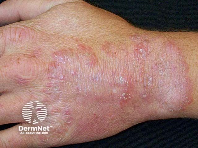 Tinea manuum