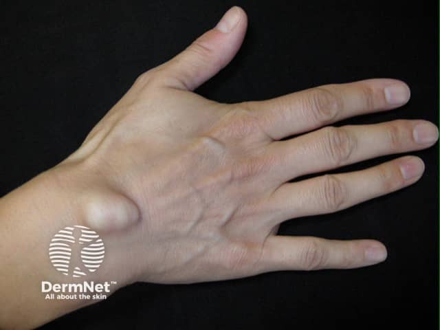 Ganglion cyst