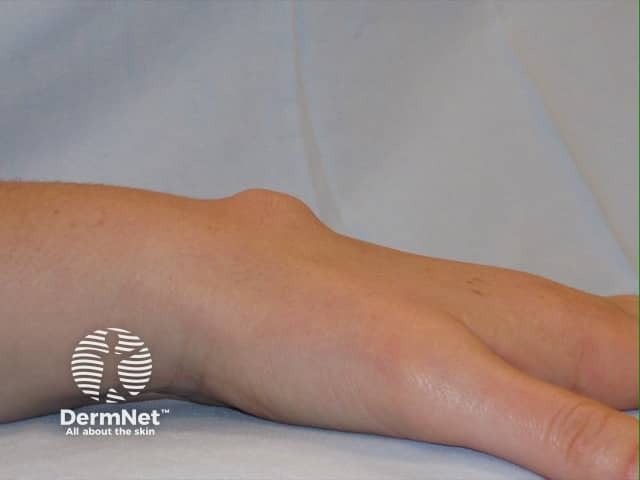 Ganglion cyst