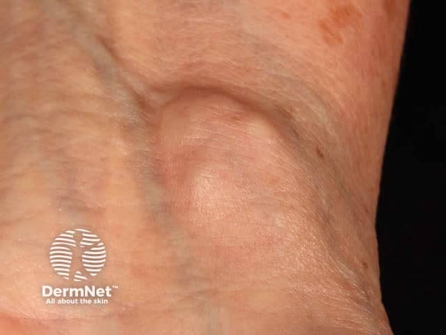 Ganglion cyst