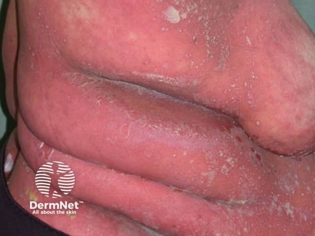 Erythrodermic generalised pustular psoriasis