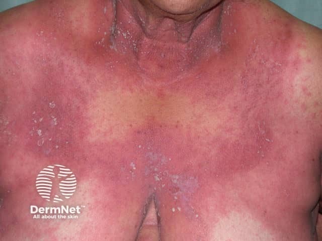 Generalised pustular psoriasis