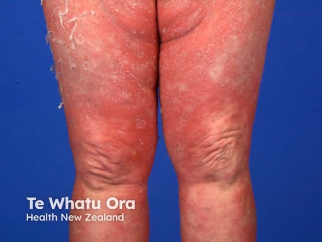 Generalised pustular psoriasis