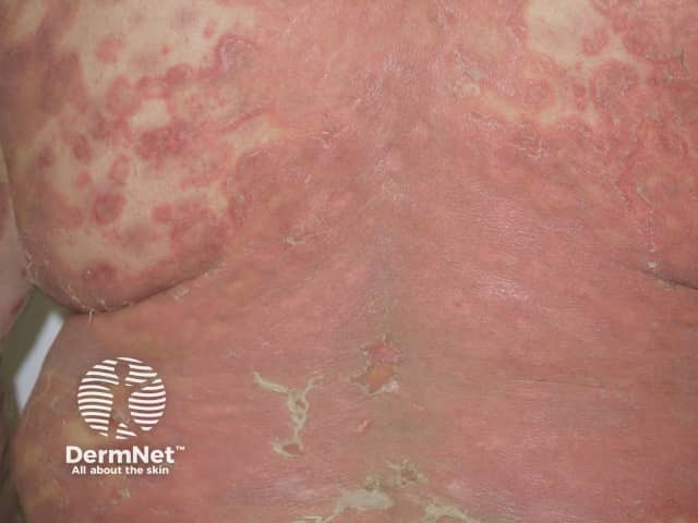 Generalised pustular psoriasis