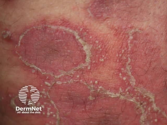 Generalised pustular psoriasis