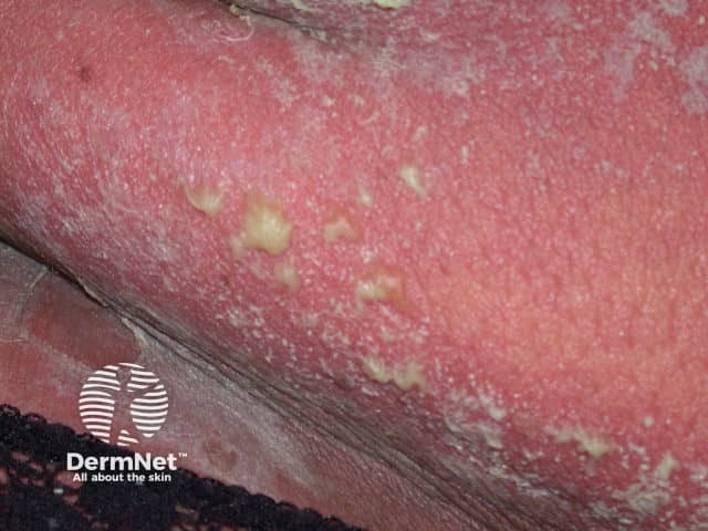 Superfical pustules in generalised pustular psoriasis