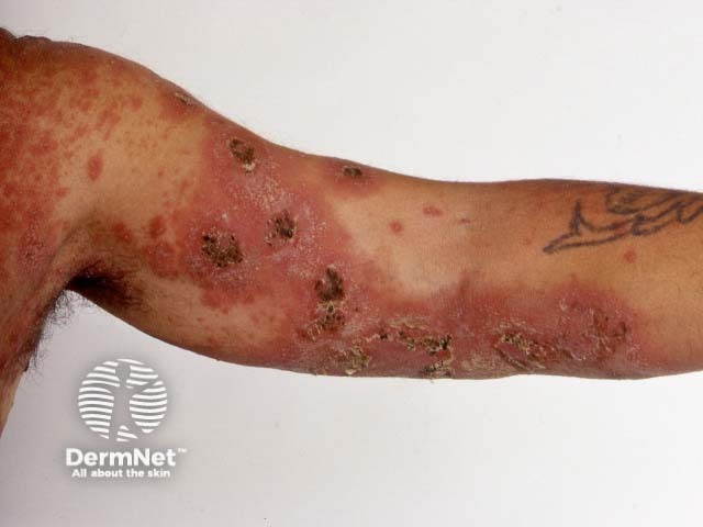 Generalised pustular psoriasis