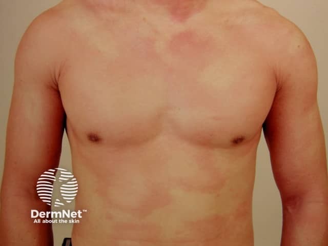 Acute urticaria