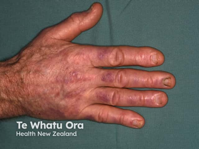 Gottron papules in dermatomyositis