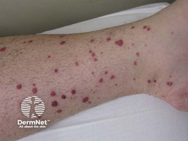 Palpable purpura