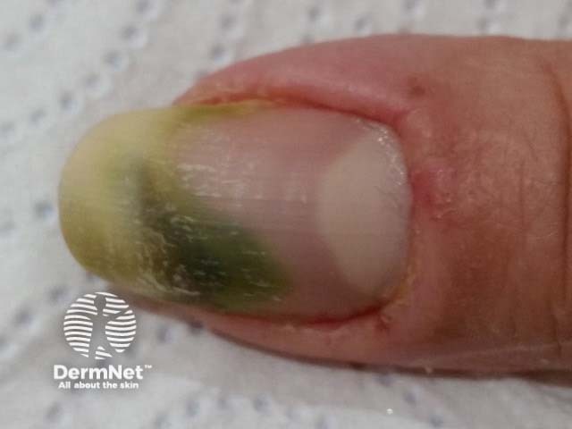 Green nail due to pseudomonas infection with paronychia