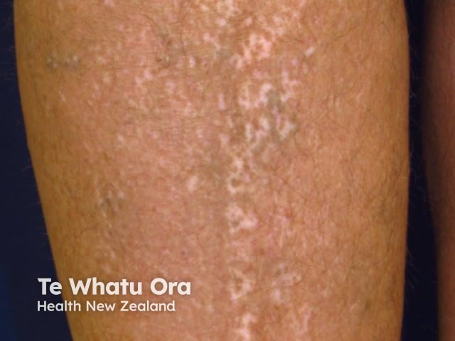 Guttate vitiligo