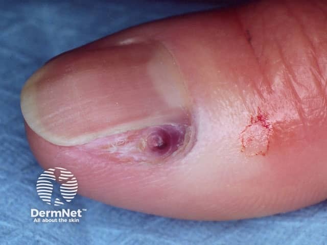 Melanoma of nail unit