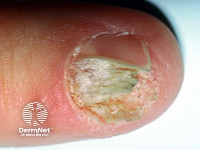 Bowen disease of nail