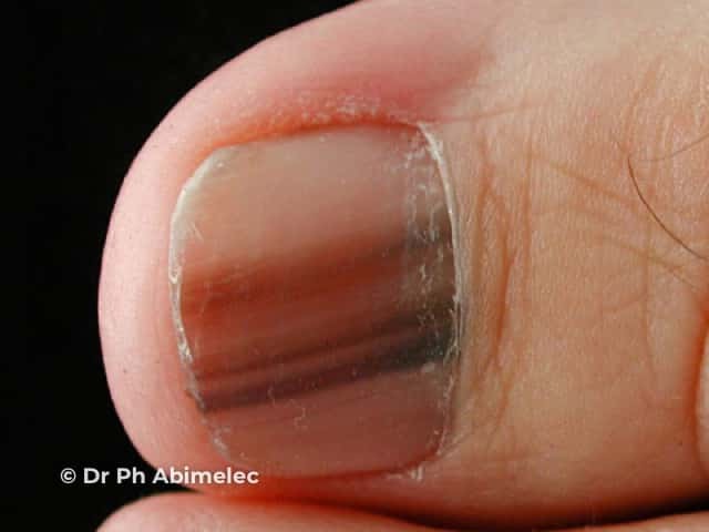 Melanoma of nail unit