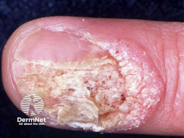 Ungual wart