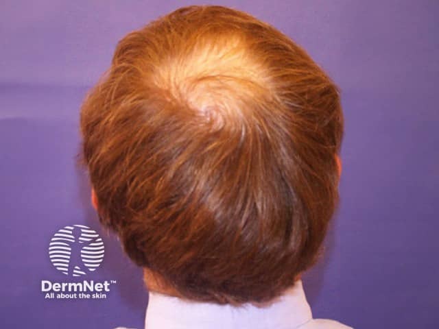 Pattern balding