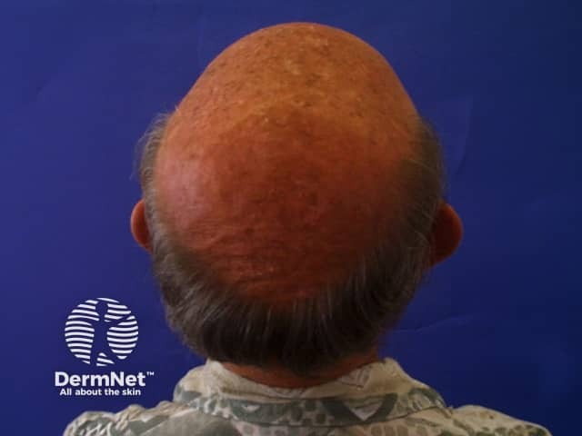 Pattern balding