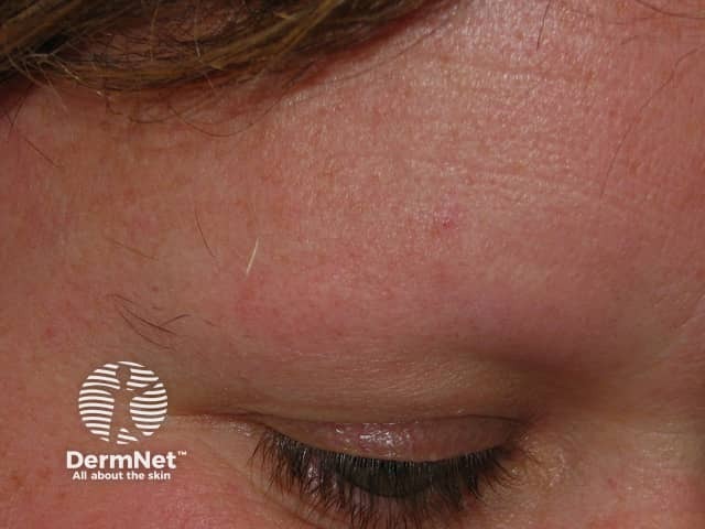 Eyebrow loss in alopecia areata