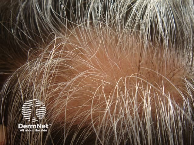 Poliosis in alopecia areata