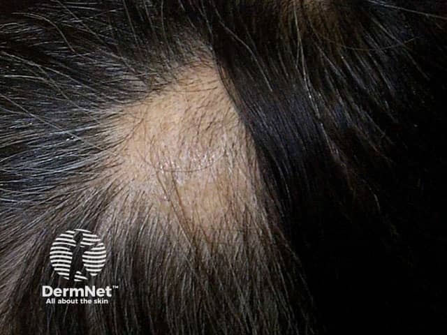 Alopecia areata