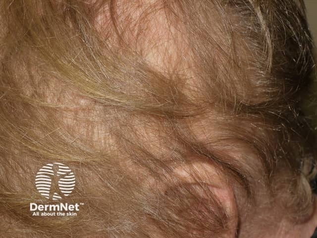 Anagen effluvium due to cranial irradiation