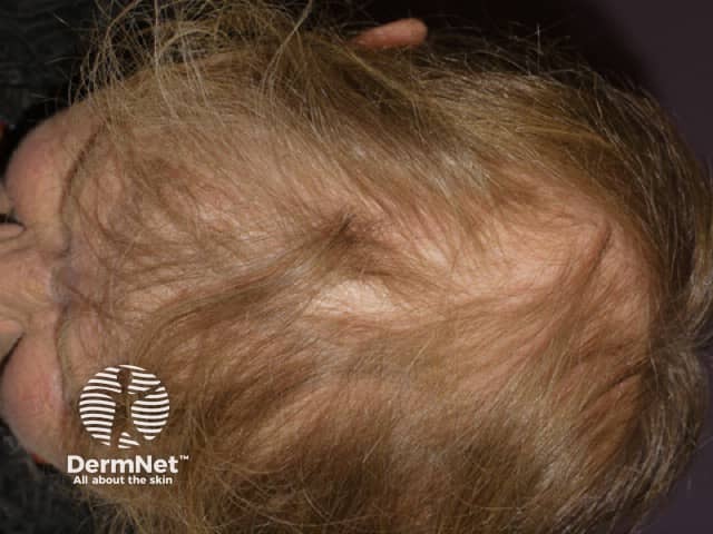 Anagen effluvium due to cranial irradiation