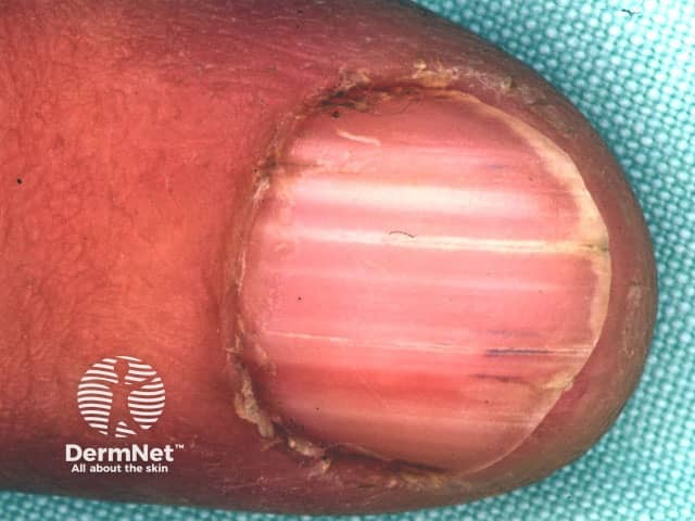 Darier nail disease