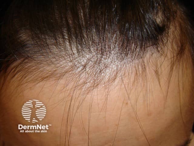 Telogen effluvium regrowth is best seen at the hairline