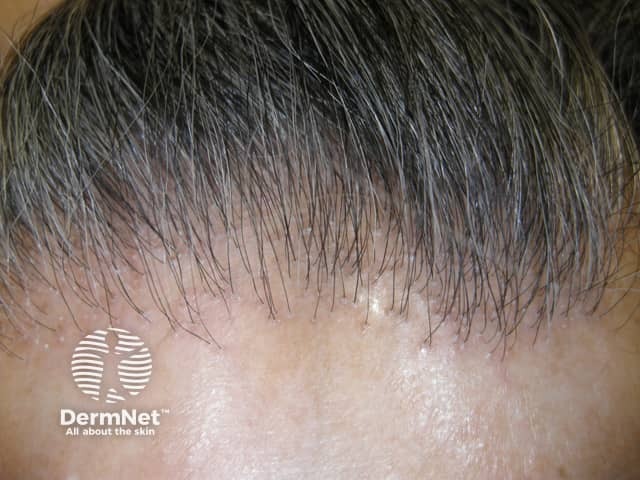 Frontal fibrosing alopecia