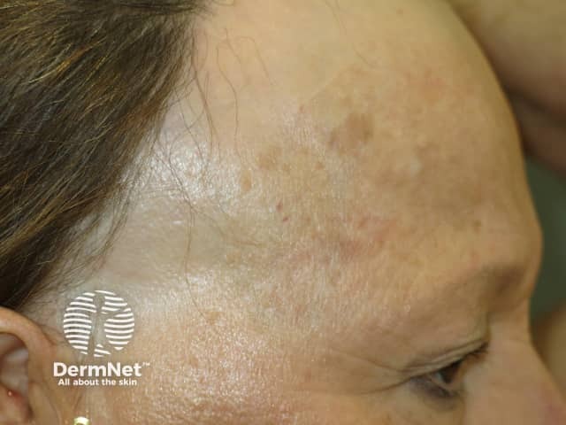 Graham Little syndrome. Scarring alopecia of anterior scalp